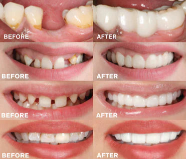 WhiteSmile Pro | Instant Dental Veneer for a Perfect Smile
